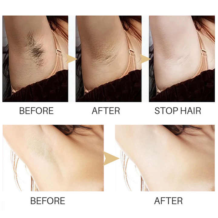 Smoothify™ Hair Removal Serum | Permanent & Painless | Buy 1 Get 1 Free
